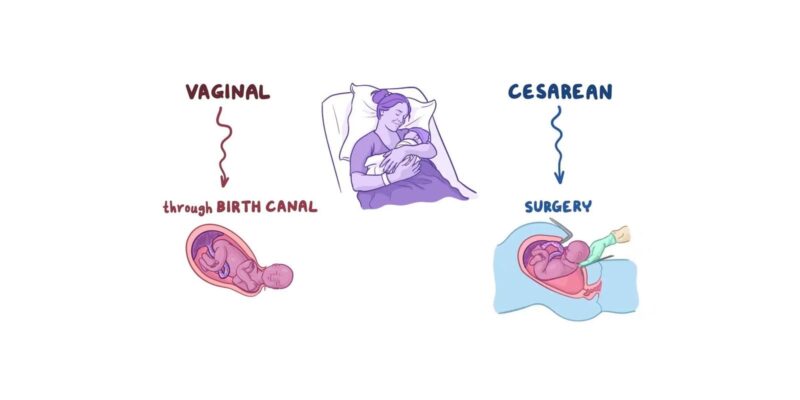 Cesarean Delivery vs Normal Delivery