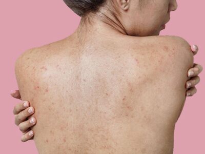 Best Home Remedies to Get Rid of Back Acne Scars