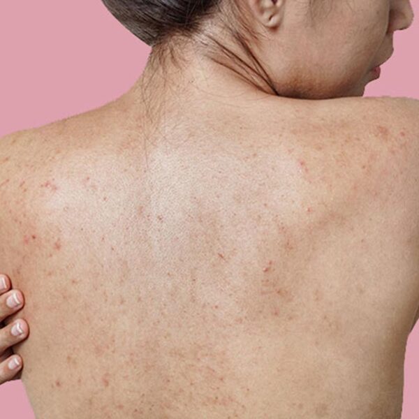 Best Home Remedies to Get Rid of Back Acne Scars